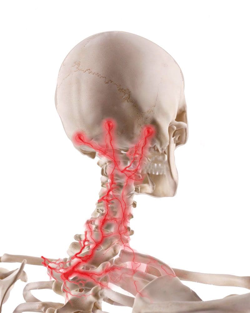 Cervicogenic Headaches Underlying Triggers Sciatica Clinic 3022