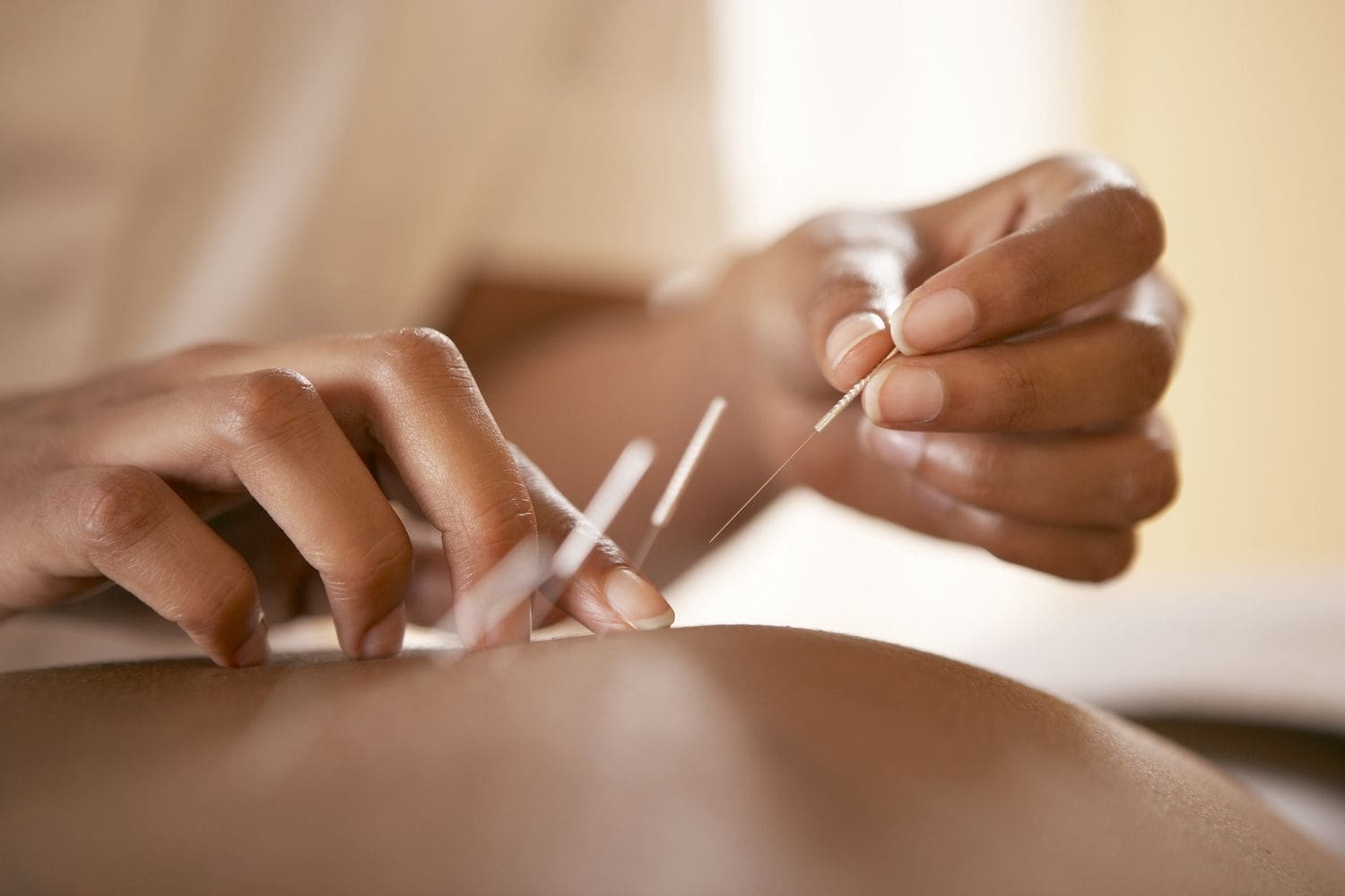 Natural Remedies for Pain Relief - Acupuncture for Pain Relief