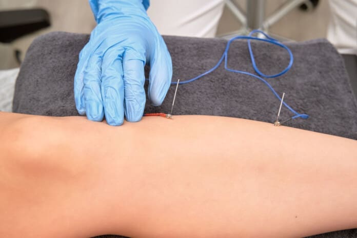 Hands of physiotherapist placing electroacupuncture needles